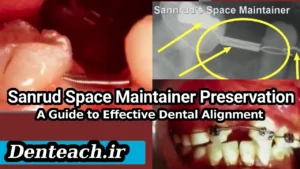 Sanrud Space Maintainer: A Guide to Effective Dental Alignment Preservation