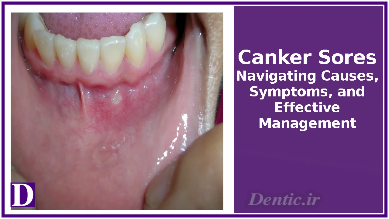 Canker Sores: Navigating Causes, Symptoms, and Effective Management