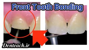 Front Tooth Bonding