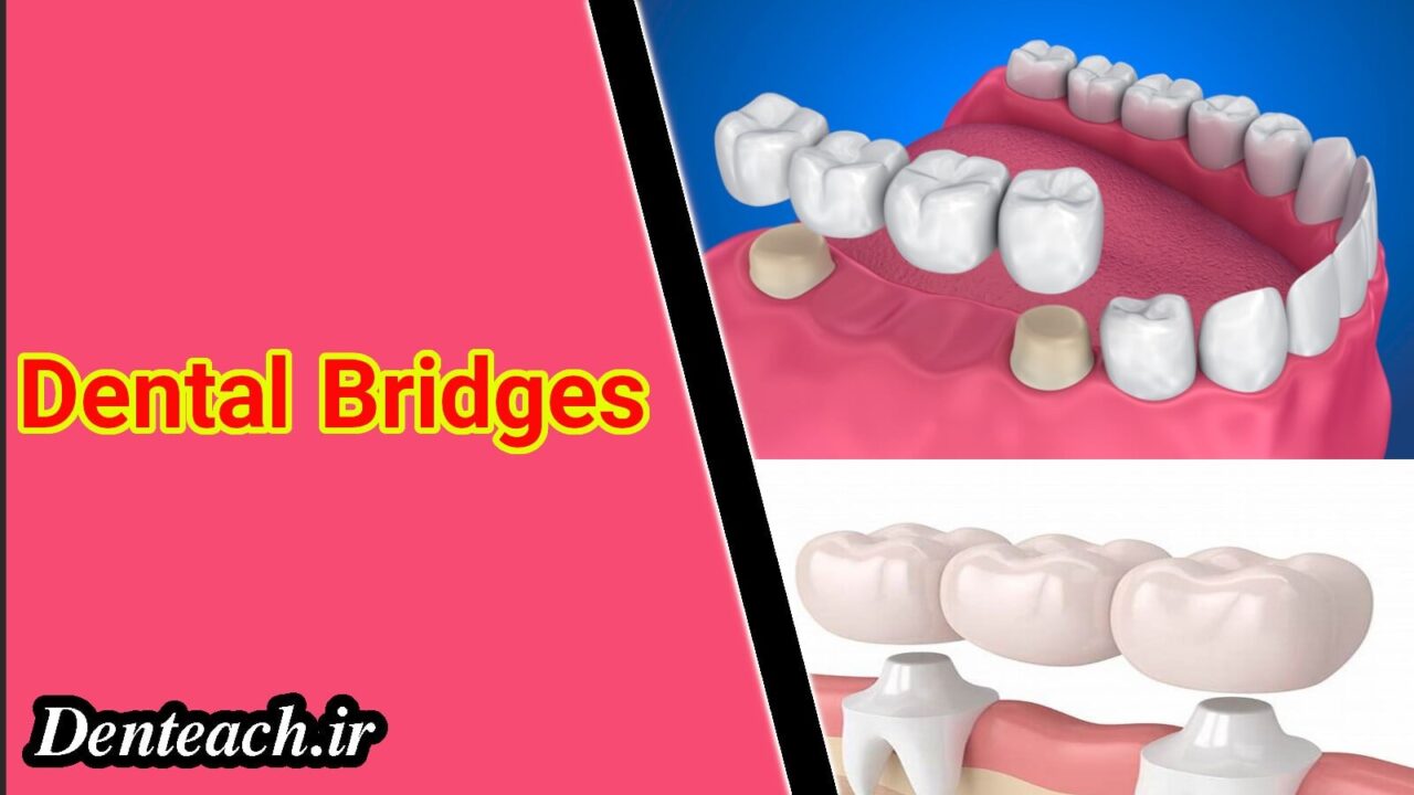 Dental Bridges