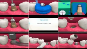 Complete Dental Implant Placement: A Step-by-Step Guide