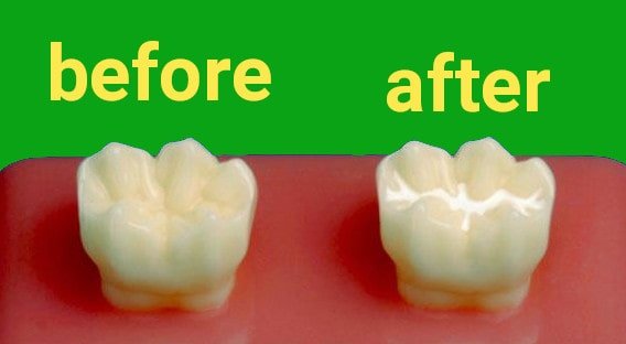 Dental Sealants: Shielding Smiles from Decay with Preventive Precision