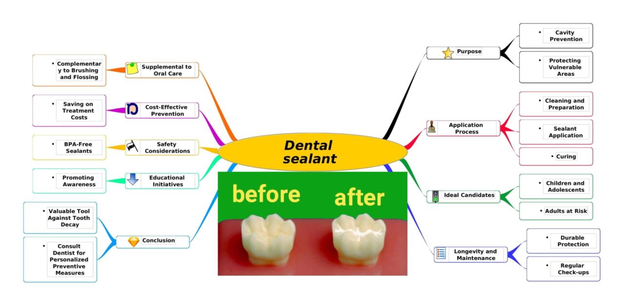 Dental sealant mind map