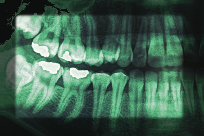 Dental X-Rays