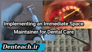 Implementing an Immediate Space Maintainer for Dental Care