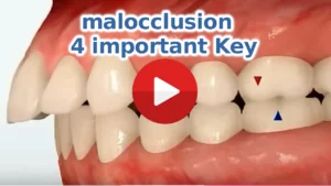 malocclusion : 4 important Key