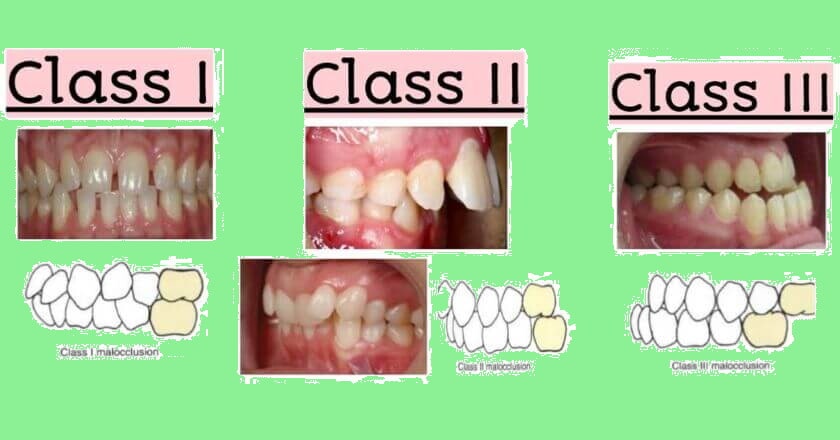 Dental Occlusion