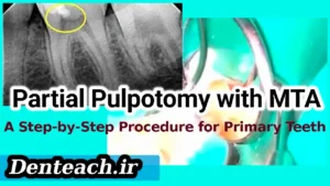 Partial Pulpotomy with MTA: A Step-by-Step Procedure for Primary Teeth