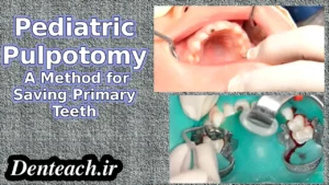 Pediatric Pulpotomy: A Method for Saving Primary Teeth