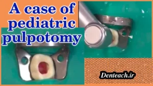 A case of pediatric pulpotomy