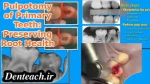 Pulpotomy of Primary Teeth: Preserving Root Health