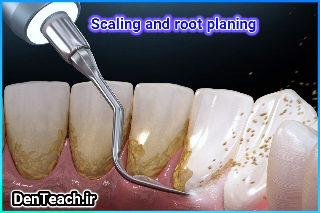 Scaling and root planing