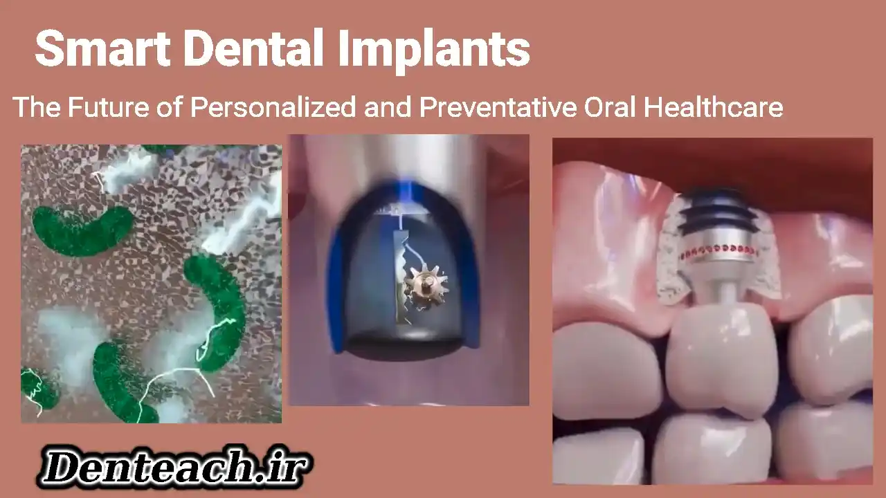 Smart Dental Implants: The Future of Personalized and Preventative Oral Healthcare