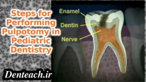 Steps for Performing Pulpotomy in Pediatric Dentistry