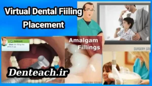 Virtual Dental Fiiling Placement