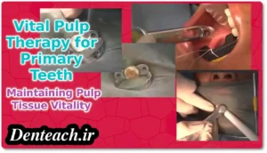 dental Pulp - Vital Pulp Therapy for Primary Teeth: Maintaining Pulp Tissue Vitality
