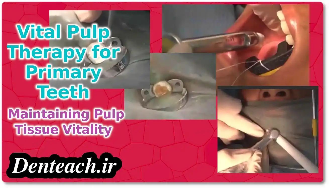 dental Pulp - Vital Pulp Therapy for Primary Teeth: Maintaining Pulp Tissue Vitality