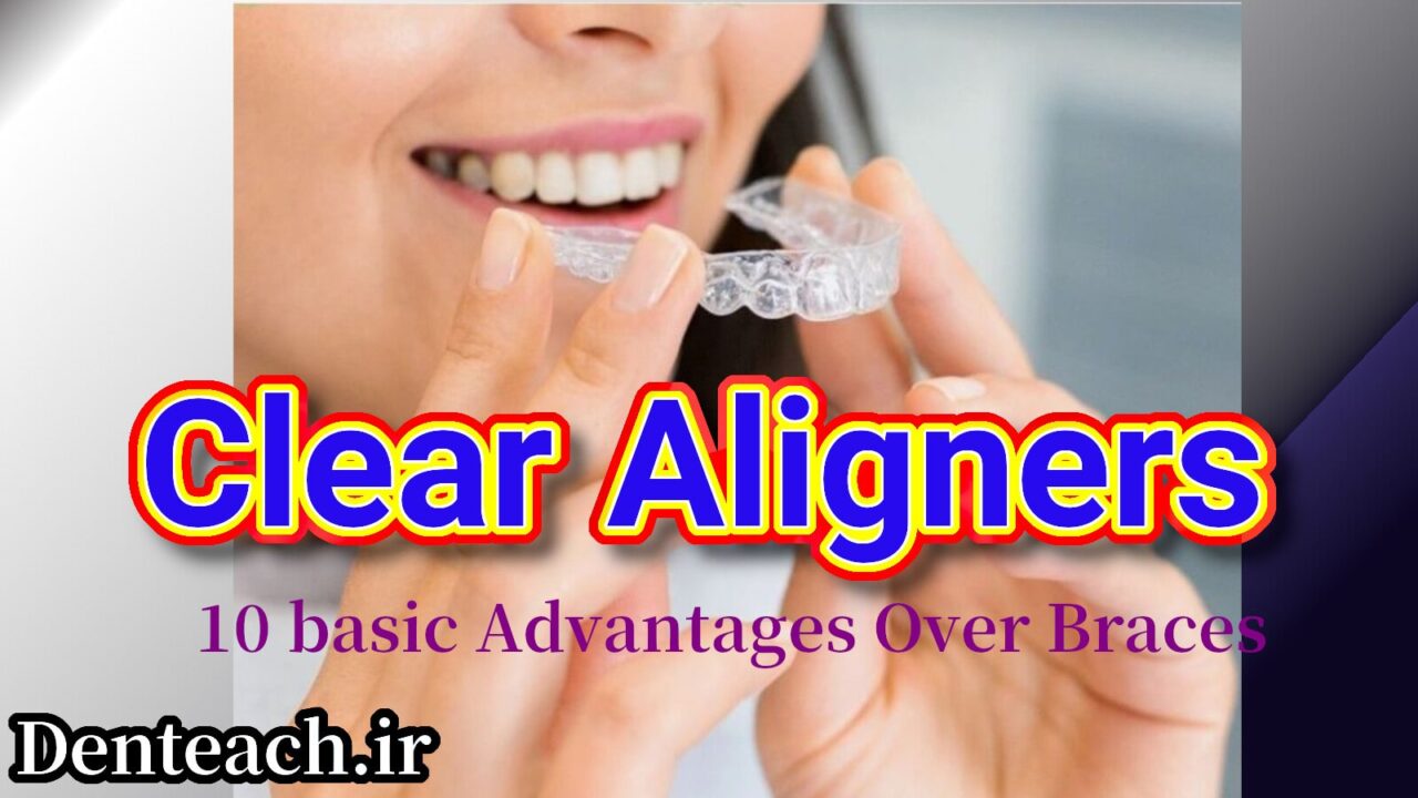 Clear Aligners