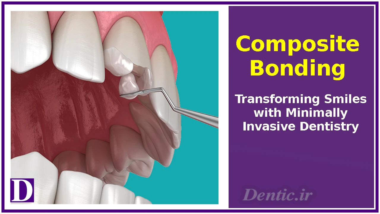Composite Bonding