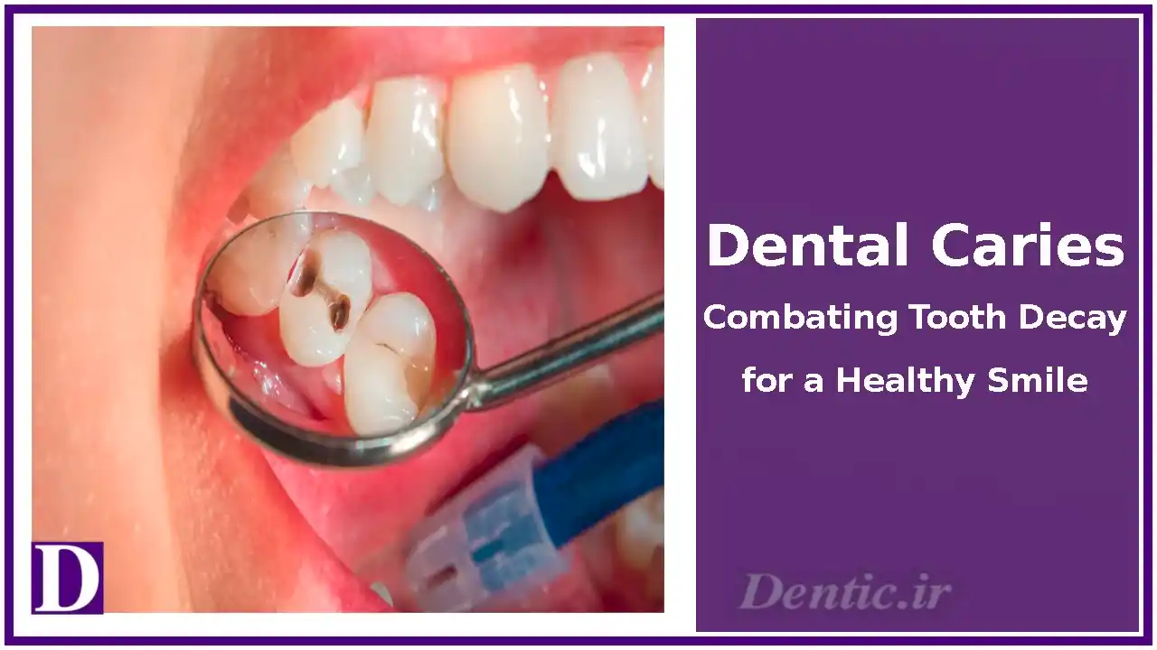 Dental Caries: Combating Tooth Decay for a Healthy Smile