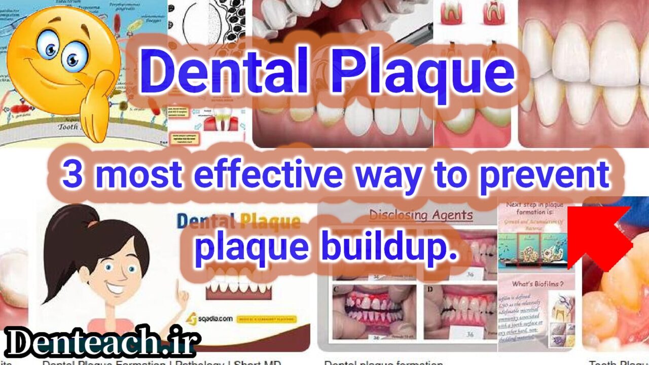 Dental Plaque
