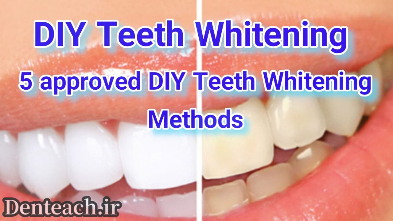 Teeth Whitening