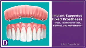 Implant-Supported Fixed Prostheses