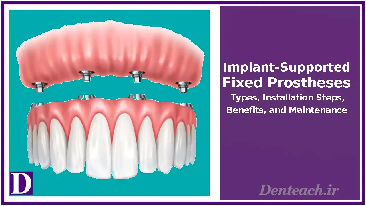 Implant-Supported Fixed Prostheses