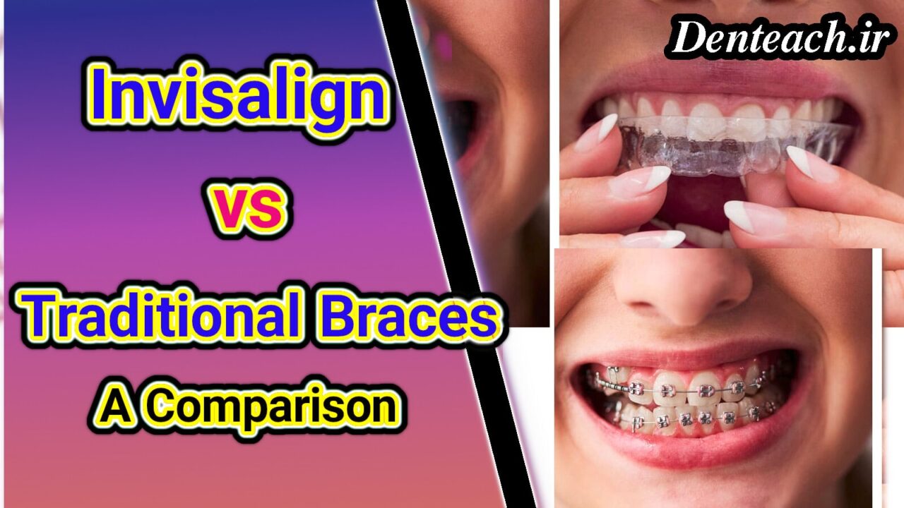 Invisalign and Traditional Braces