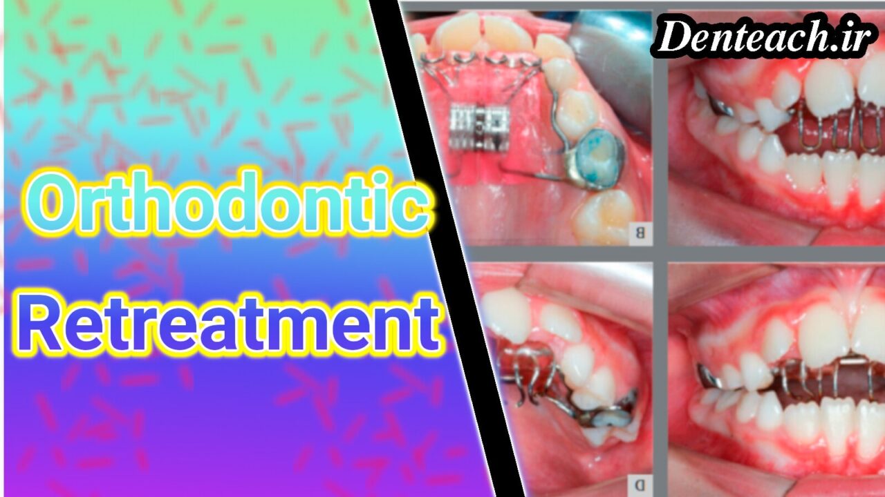 Orthodontic Retreatment