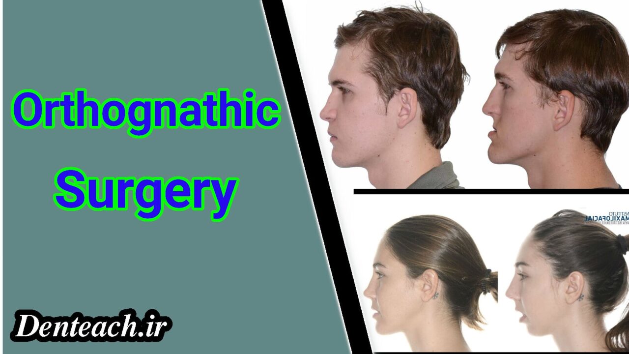 Orthognathic Surgery