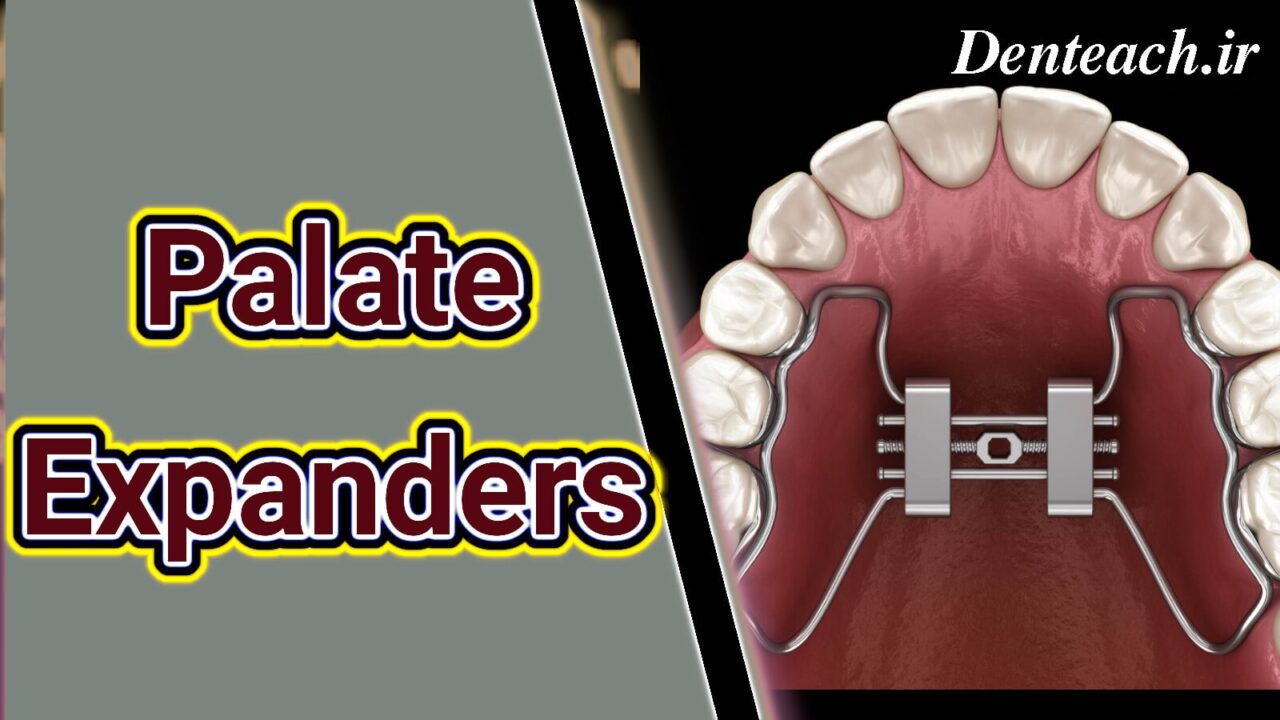 Palate Expanders
