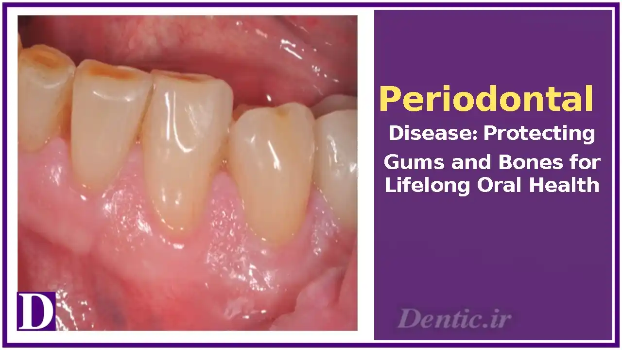 Periodontal Disease: Protecting Gums and Bones for Lifelong Oral Health