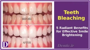 Teeth Bleaching