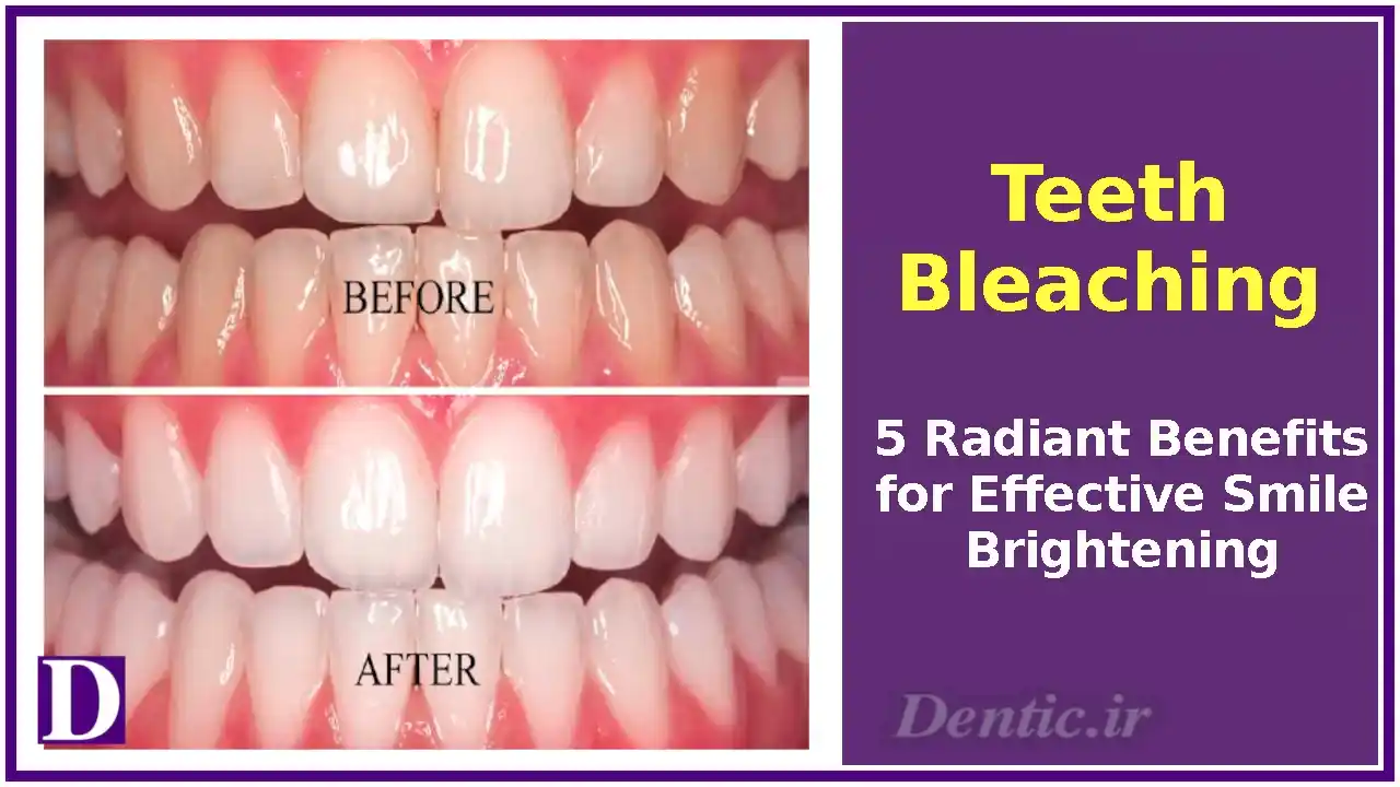 Teeth Bleaching