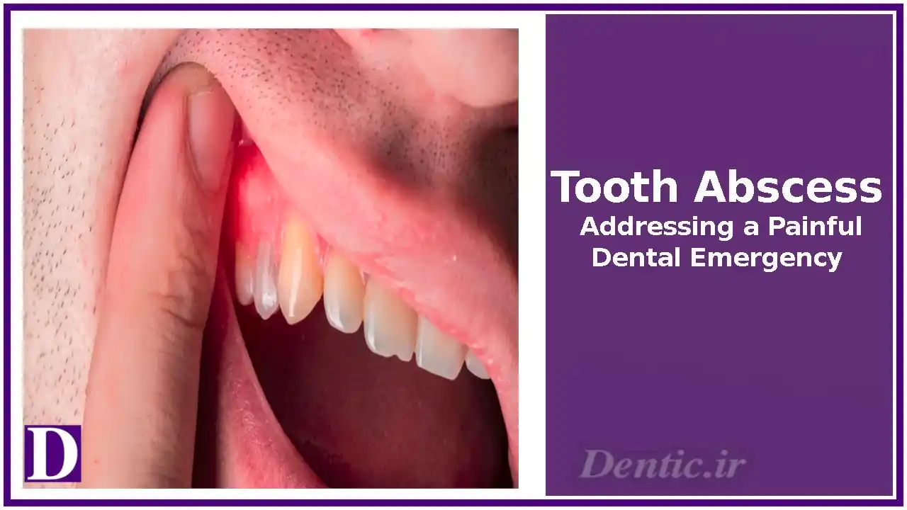 Tooth Abscess: Addressing a Painful Dental Emergency