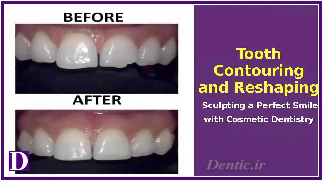 Tooth Contouring and Reshaping: Sculpting a Perfect Smile with Cosmetic Dentistry