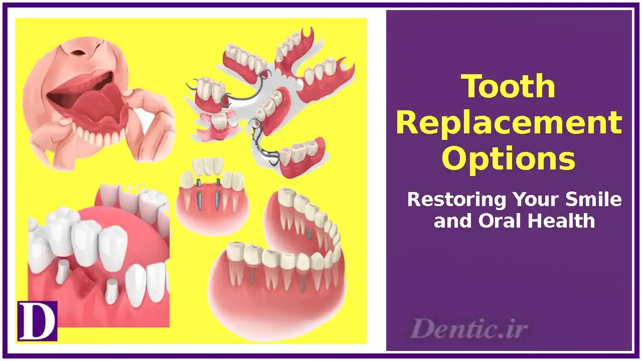 Tooth Replacement Options: Restoring Your Smile and Oral Health