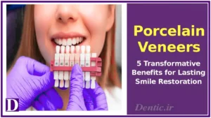 Porcelain Veneers